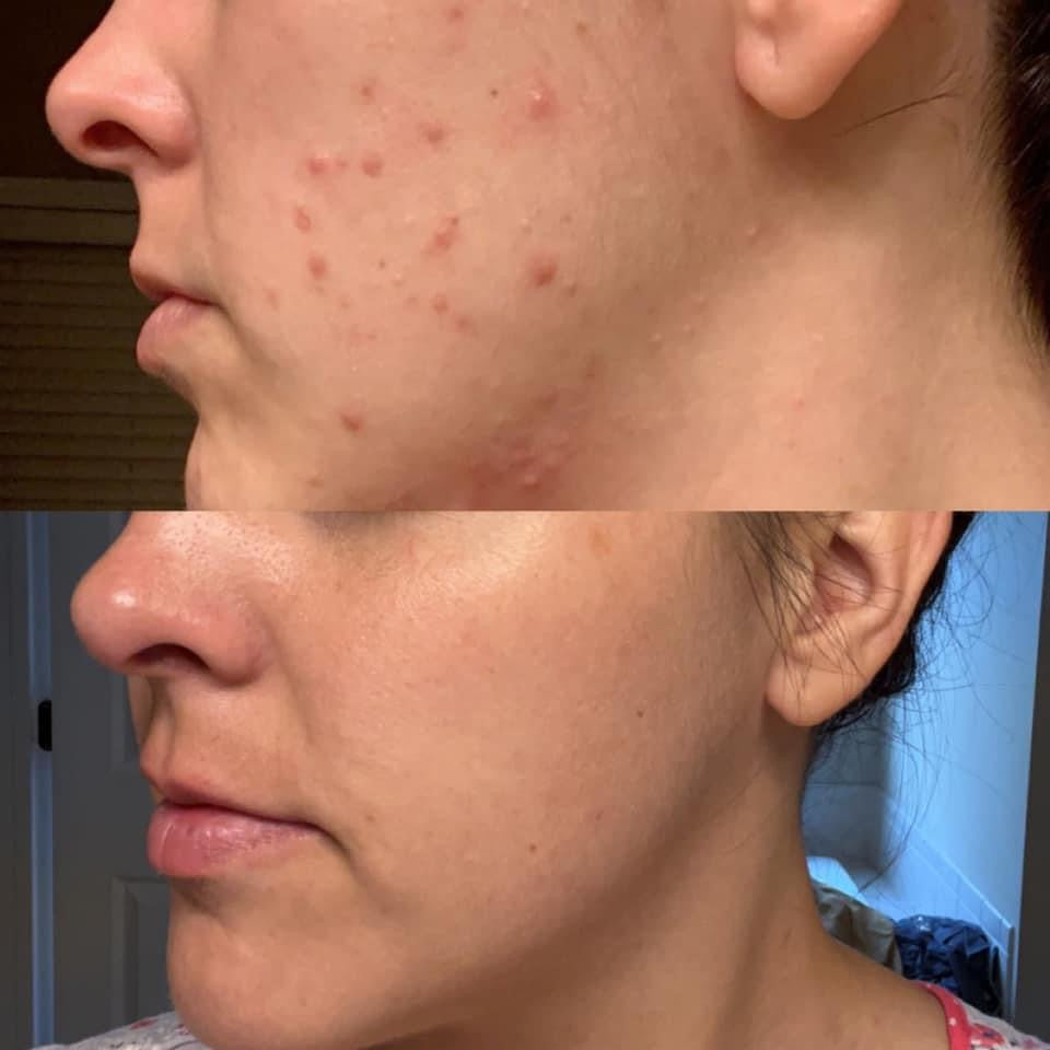 Before-and-after close-up of a woman’s lower face showing visible blemishes in the before image and a clearer, smoother complexion in the after image.
