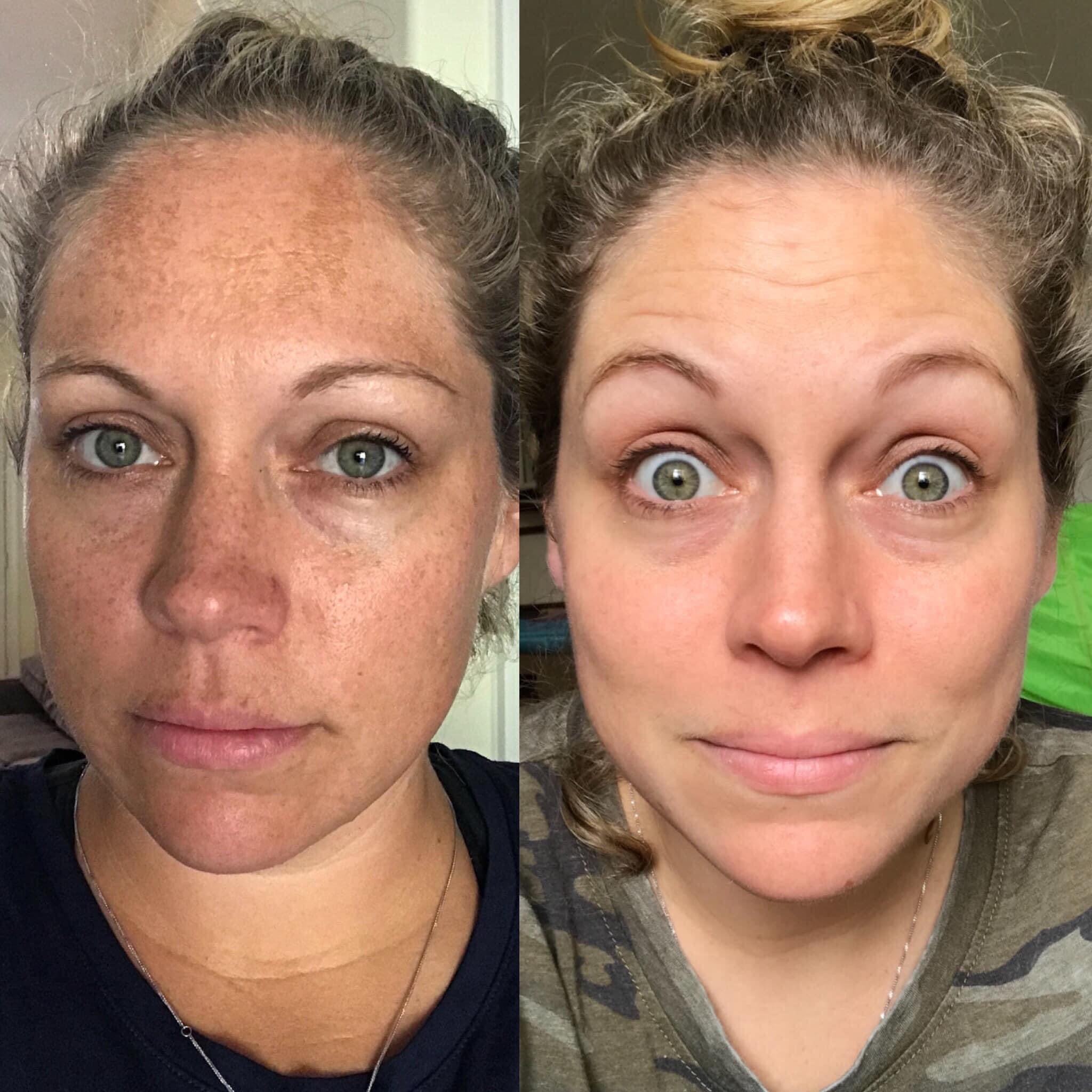 Side-by-side before-and-after images showing uneven skin tone and discoloration in the before photo contrasted with a bright, even, and smooth complexion in the after photo.
