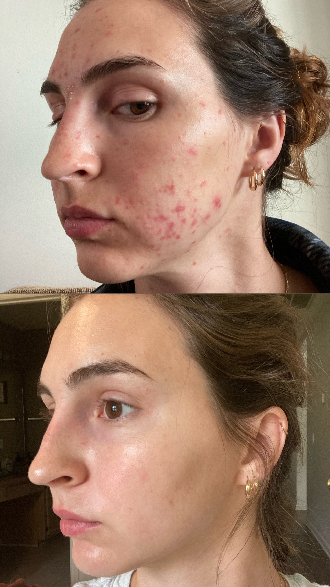 Vertical before-and-after images of a woman’s side profile showing significant redness in the before photo and a visibly calmer, clearer, glowing complexion in the after photo.