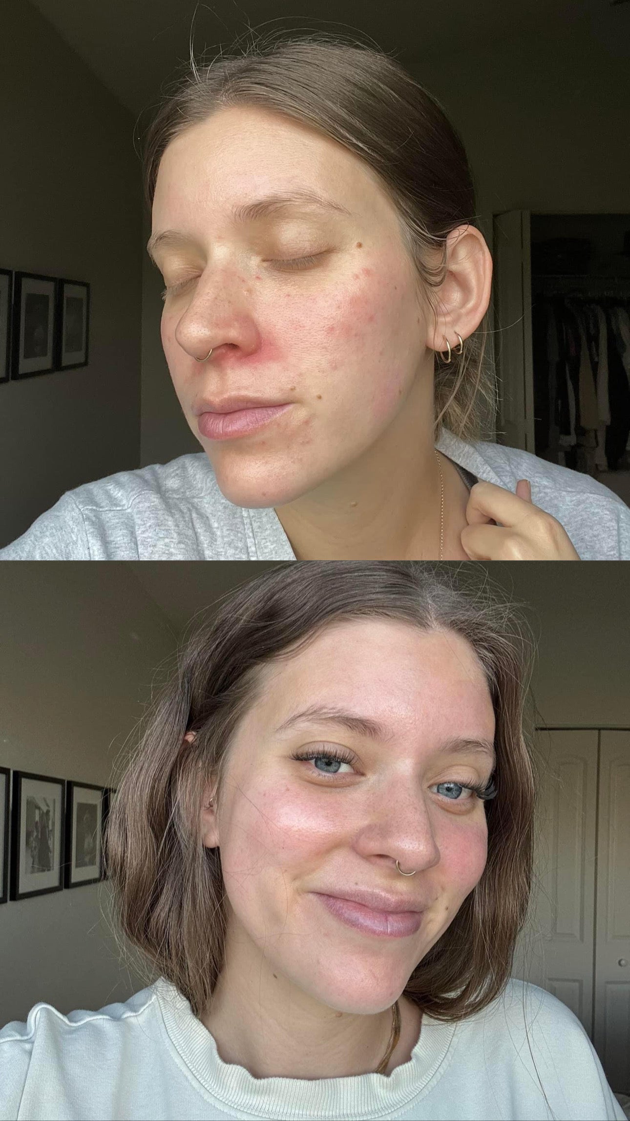 Vertical before-and-after images showing redness and blemishes around the nose and cheeks in the before photo, with a clearer, brighter, more even complexion in the after photo.